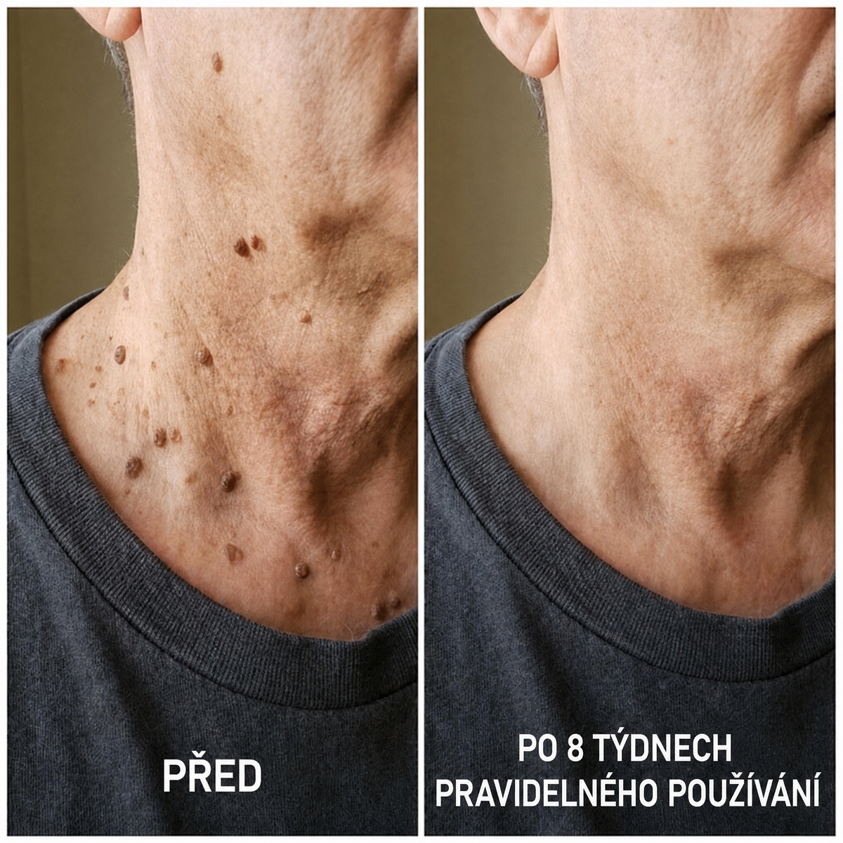 Zlerima — Pokročilý Keratolytický Krém na Drsné, Vystouplé Seboroické Keratózy